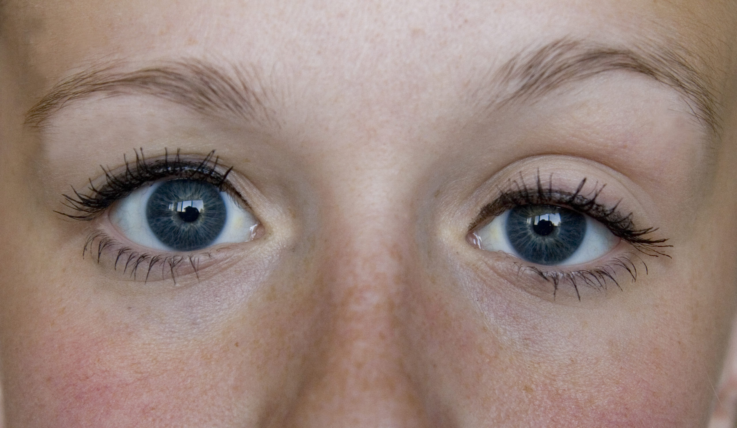 5 Powerful Ways to Fix a Lazy Eye in Adults: A Journey Towards Clear Vision