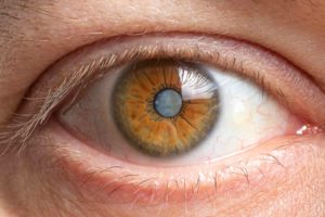 eye close up with cataracts and cloudy vision