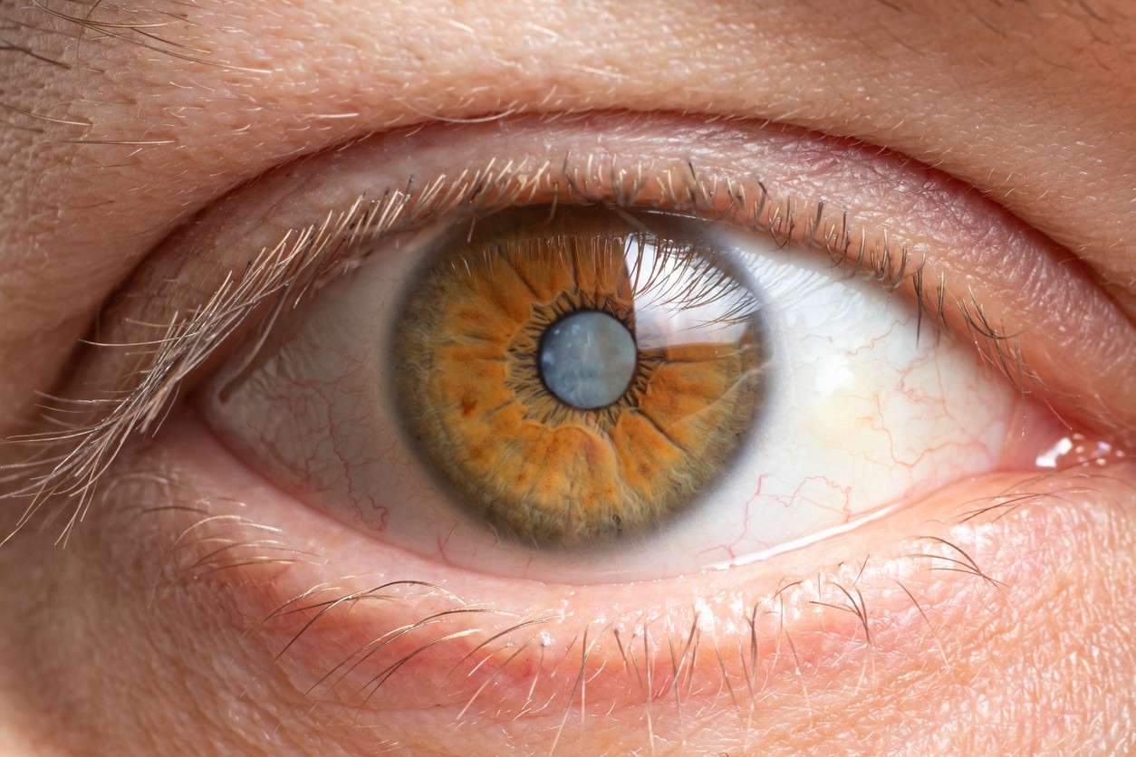 cataract-in-eye