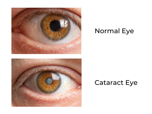 what-are-cataracts-lasik-denver-cataract-surgery