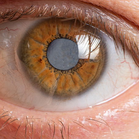 Close of an eye with a mature cataract